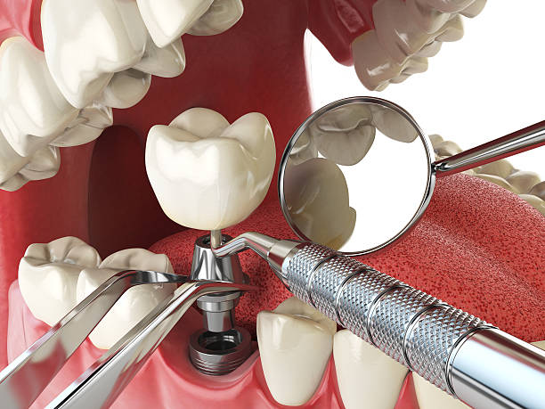 Best Chipped Tooth Repair Near Me  in Orion, IL